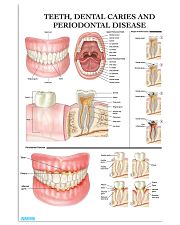 Dental Caries and Periodontal Disease 11x17 Poster front