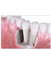 Dental Implants Poster 17x11 Poster front