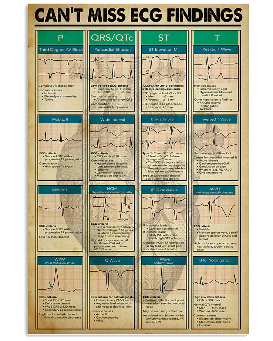 Can't Miss ECG Findings Cardiologist 11x17 Poster