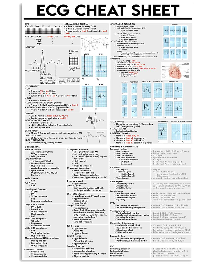 Paramedic ECG Cheat Sheet 11x17 Poster