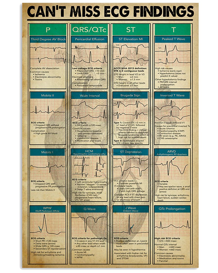 Paramedic Can't Miss ECG Findings 11x17 Poster