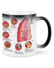 pulmonology disease of the lungs lqt pml Mugs tile