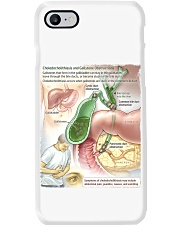 gastroenterology choledocholithiasis jama lqt lbs Phone Case tile