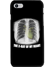 The X-ray Of My Heart Phone Case tile