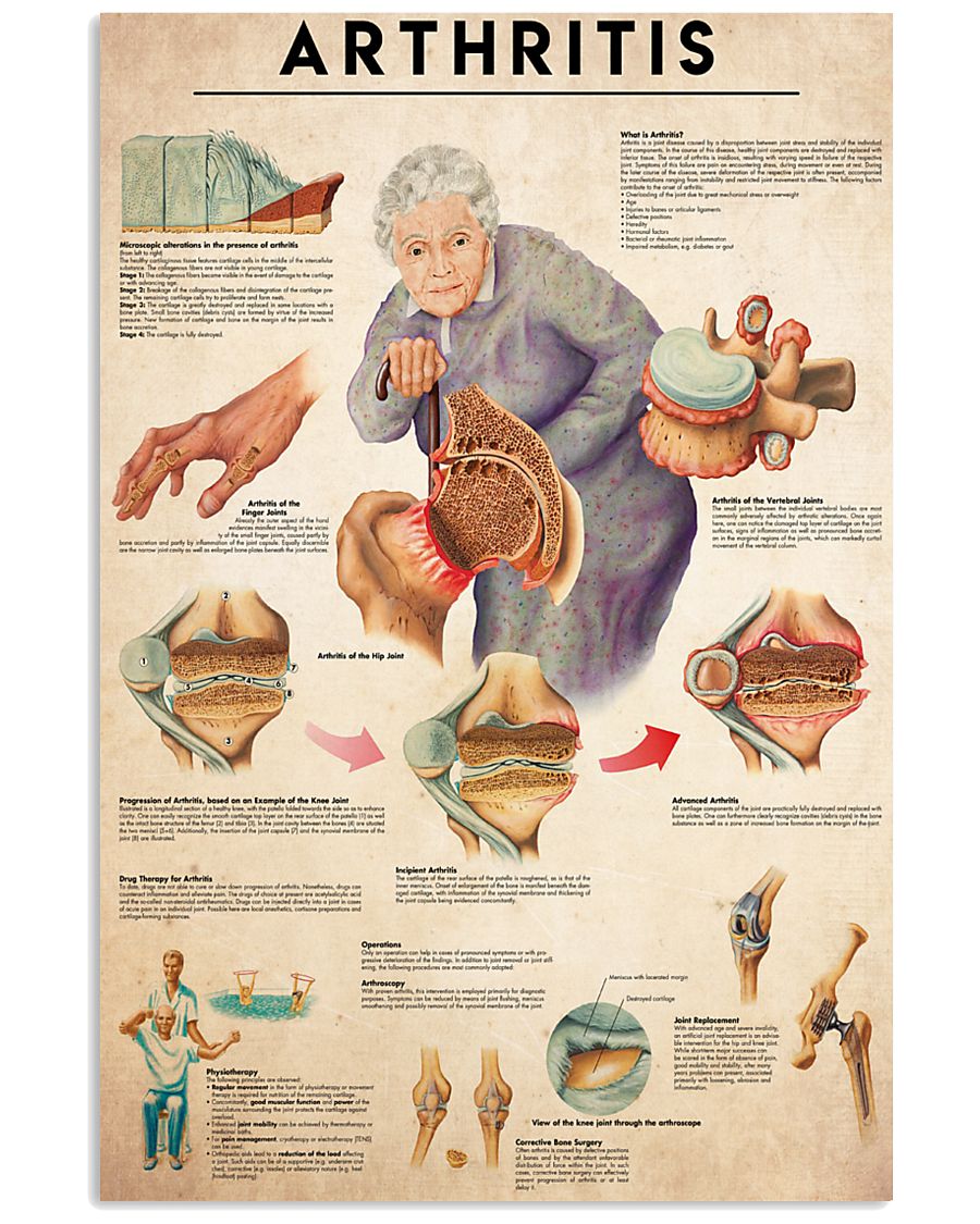 Arthritis 24x36 Poster