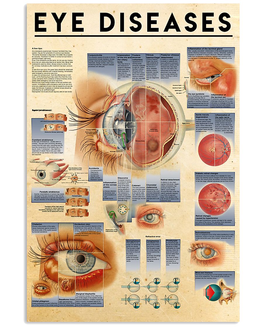 eye-diseases 11x17 Poster