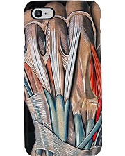 orthopedic hand case Phone Case i-phone-7-case