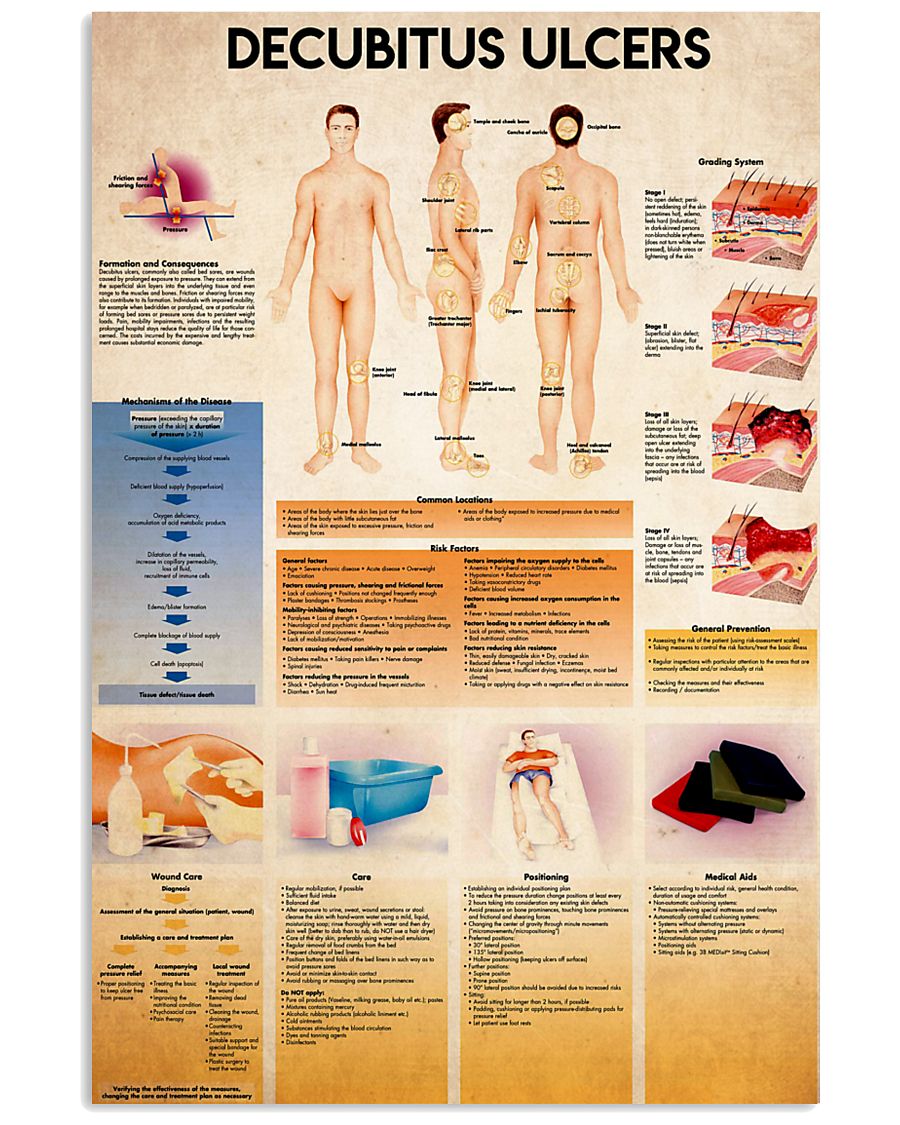 decubitus 24x36 Poster
